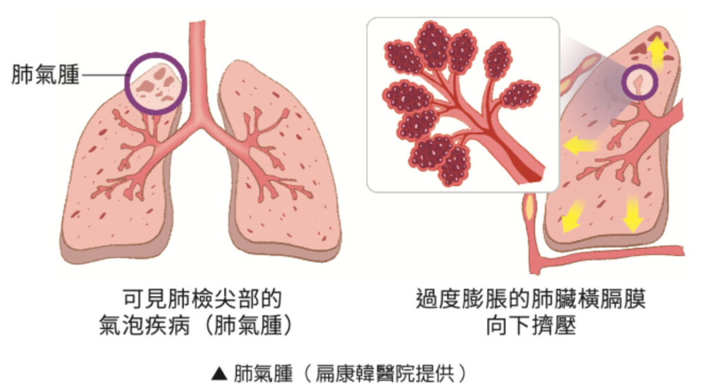 肺氣腫